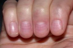 Как выглядят здоровые ногти и как их внешний вид связан со здоровьем?